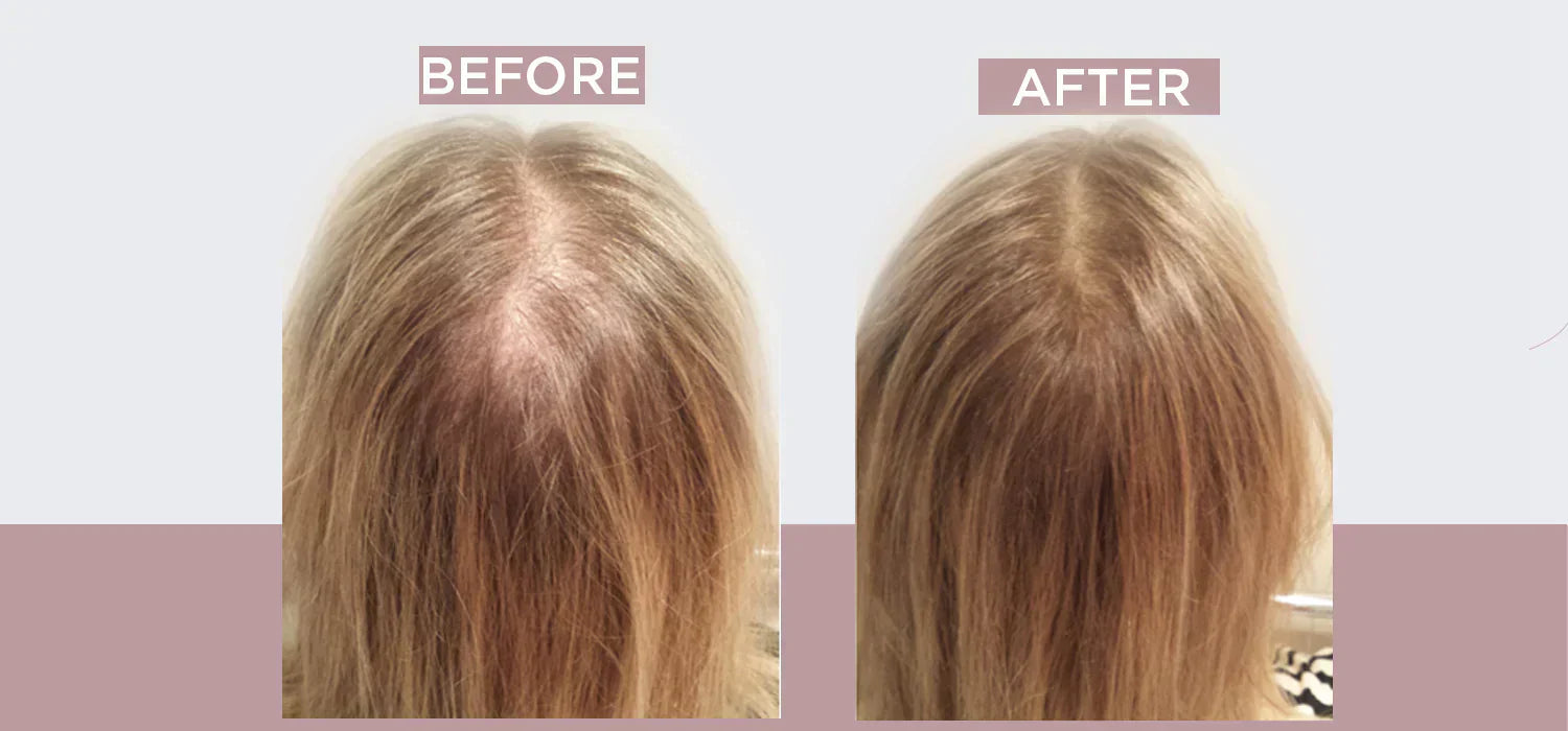 6 Ways to Hide Hair Loss and Thinning Hair in a Female