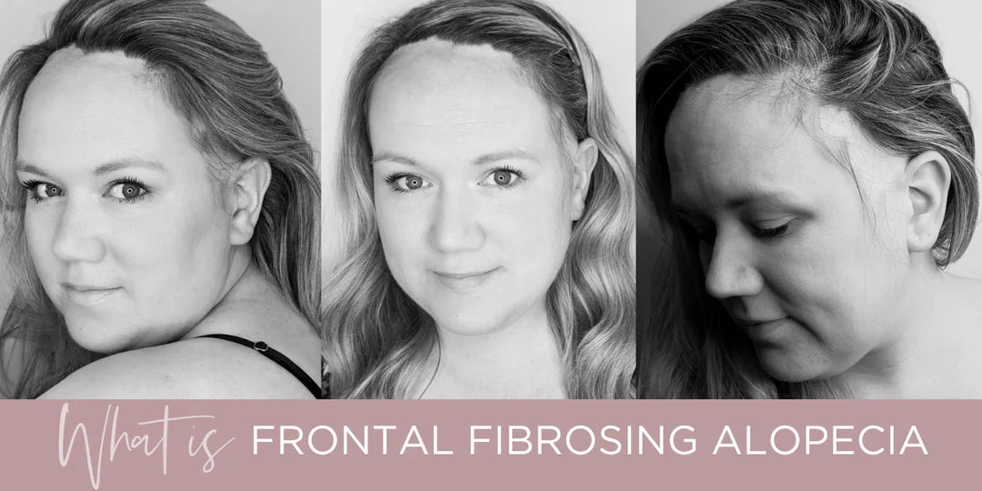 Frontal Fibrosing Alopecia