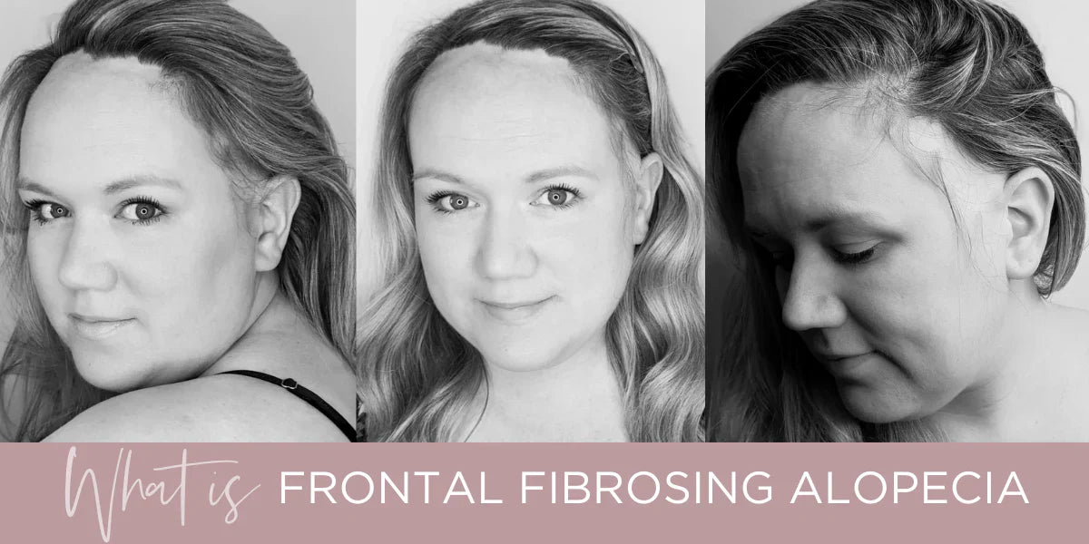 Frontal Fibrosing Alopecia